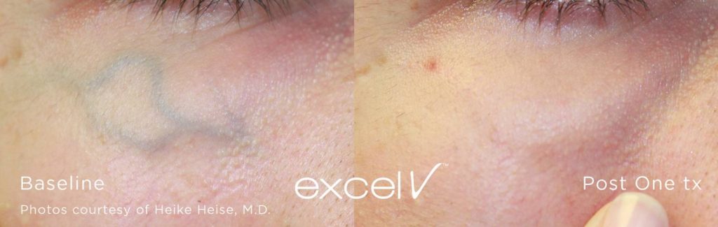 Excel® V Laser Treatment Spider Veins Before and After 3