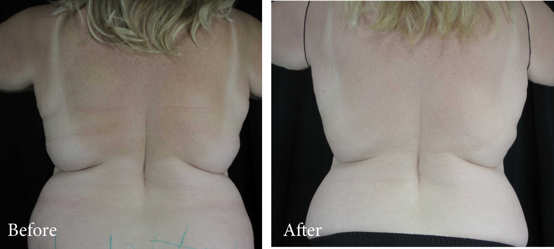 Coolsculpting Before and After 5