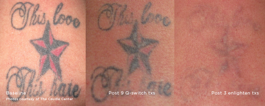 Enlighten Laser Tattoo Removal Results