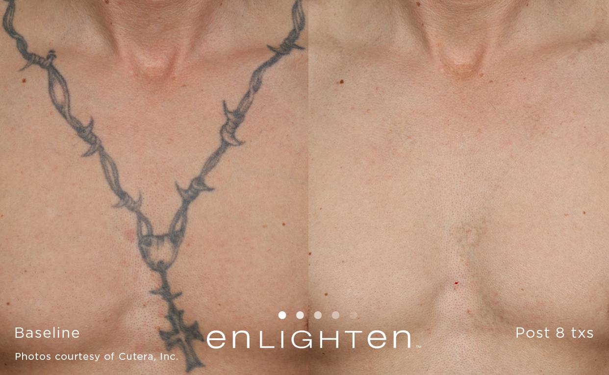 Enlighten Laser Tattoo Removal Results 3