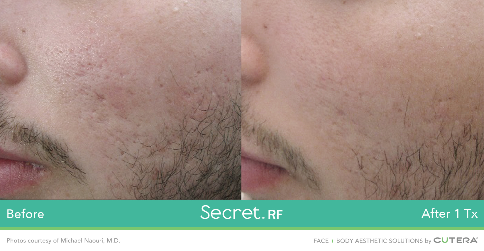 Secret RF Acne Scar Treatment Results 2