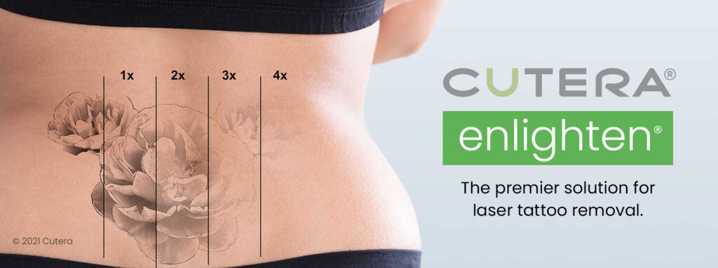 Cutera Enlighten Laser Tattoo Removal