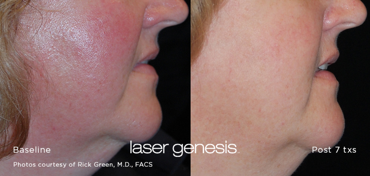 Laser Genesis Before and After