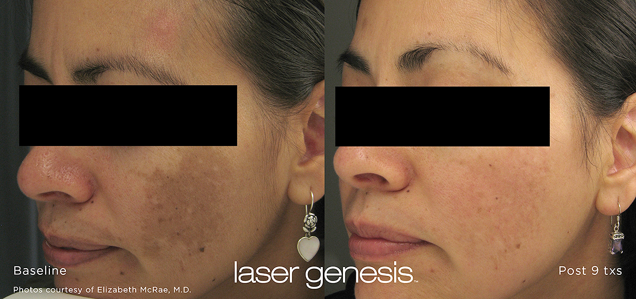 Laser Genesis Before and After 2